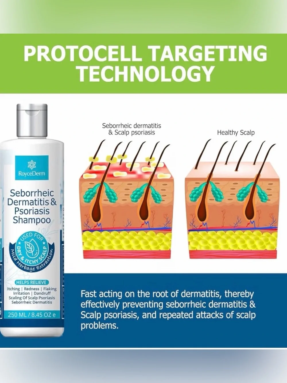 RoyceDerm Seborrheic Dermatitis & Psoriasis Shampoo 250mL EXP 2027 New / Sealed